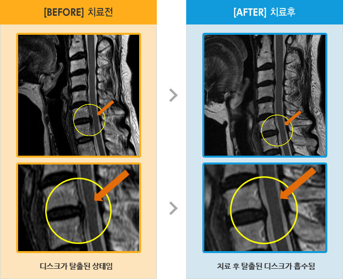 자생한방병원 치료사례 MRI로 보는 치료결과-오른쪽 어깨와 팔 통증
