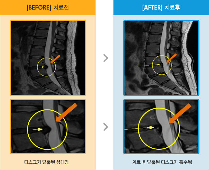 자생한방병원 치료사례 MRI로 보는 치료결과-허리 통증과 왼쪽 다리 저림