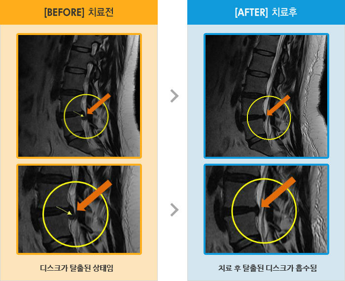 자생한방병원 치료사례 MRI로 보는 치료결과-앉아있을때 허리통증, 왼쪽 엉치부터 종아리까지 저림