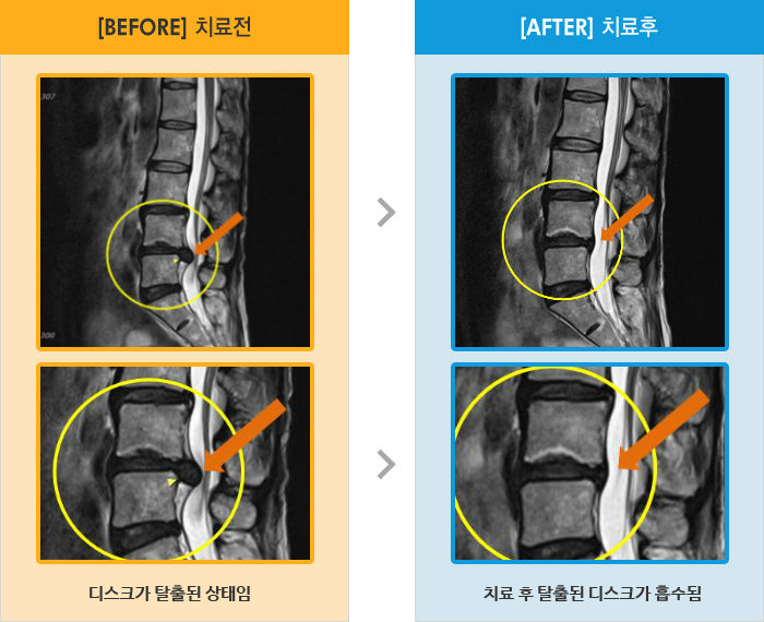 자생한방병원 치료사례 MRI로 보는 치료결과-허리 골반 통증, 허리 숙일때 다리가 당김