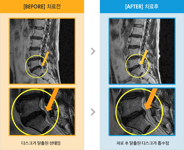 자생한방병원 치료사례 MRI로 보는 치료결과-허리와 왼쪽 다리통증, 화장실 이용과 양말신기 불편