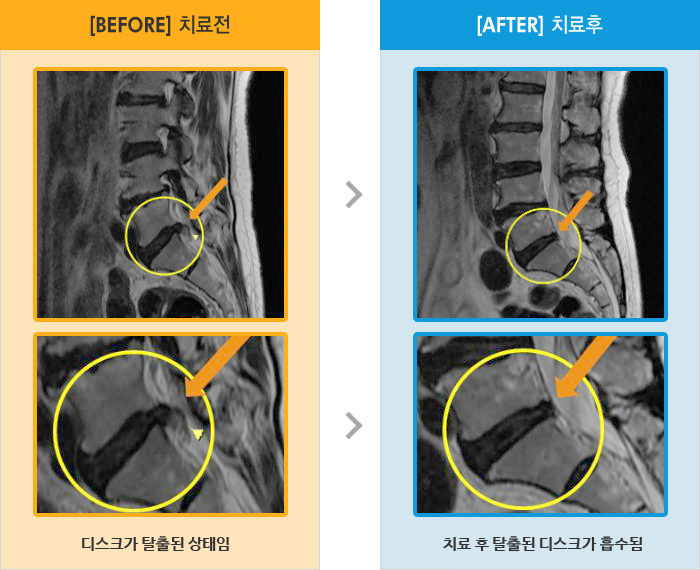 자생한방병원 치료사례 MRI로 보는 치료결과-왼쪽다리 저림