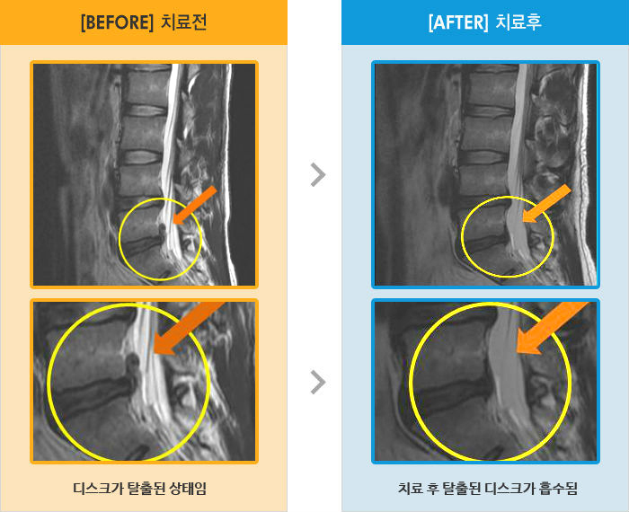 자생한방병원 치료사례 MRI로 보는 치료결과-하요부 통증으로 허리를 구부릴 수 없어 내원