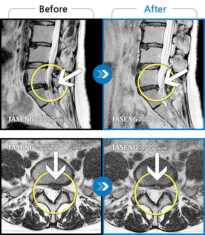 자생한방병원 치료사례 MRI로 보는 치료결과-허리가 아프고 왼쪽 엉치부터 종아리 외측까지 다리가 당기고 아파서 잠도 설쳤다.