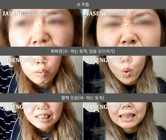 자생한방병원 치료사례 MRI로 보는 치료결과-열감기 증상이 있은 후 얼굴에 마비가 왔다.