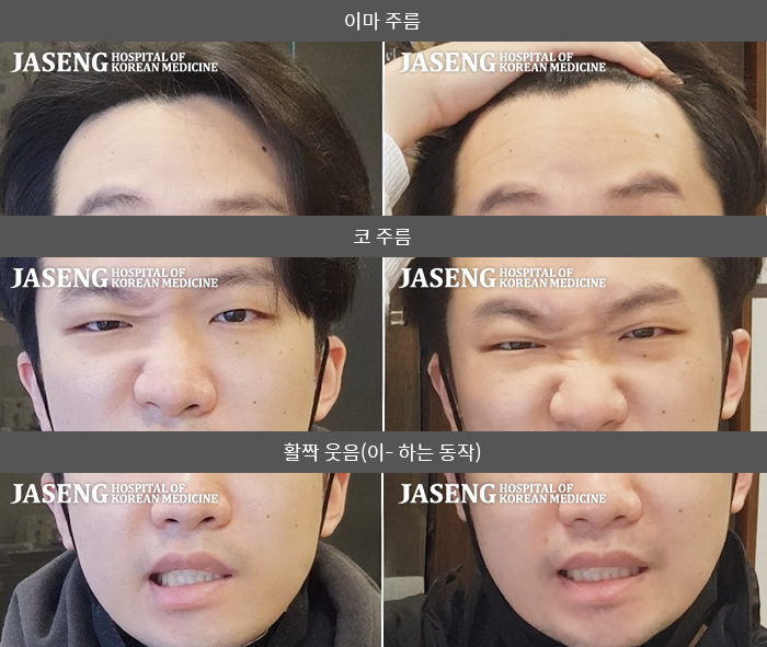 자생한방병원 치료사례 MRI로 보는 치료결과-왼쪽 눈이 잘 감기지 않고 왼쪽 안면부 전체가 마비된 느낌이다. 