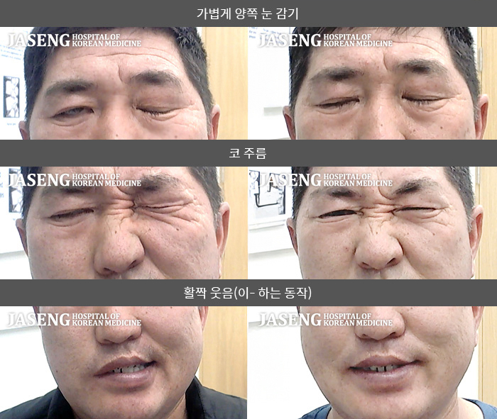 자생한방병원 치료사례 MRI로 보는 치료결과-우측 눈이 안감기고 혀가 마비되는 느낌으로 입도 마비되어 좌측으로 돌아감 