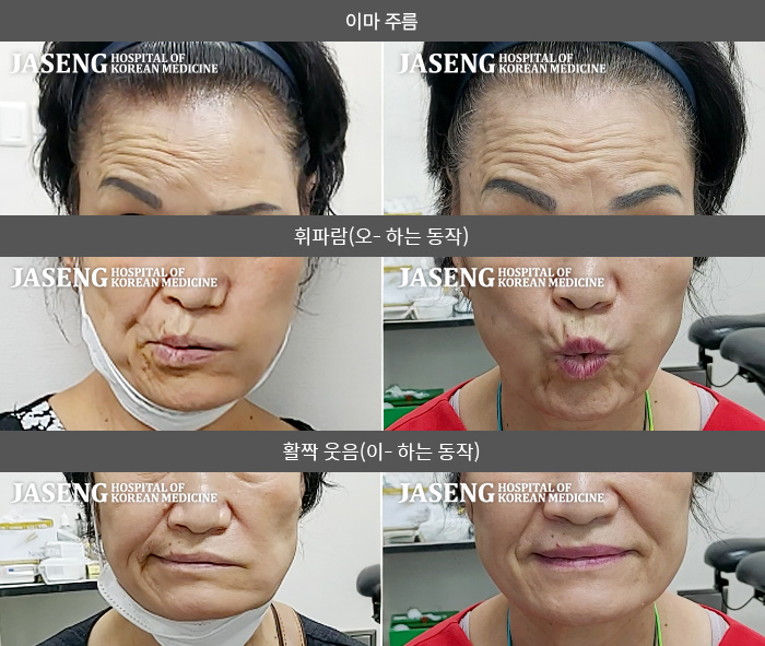 자생한방병원 치료사례 MRI로 보는 치료결과-이마에 주름을 잡을 수 없다. 식사 시 음식물이 흘러내리고 음식물이 끼이며 양치할 때 물이 새어나온다.