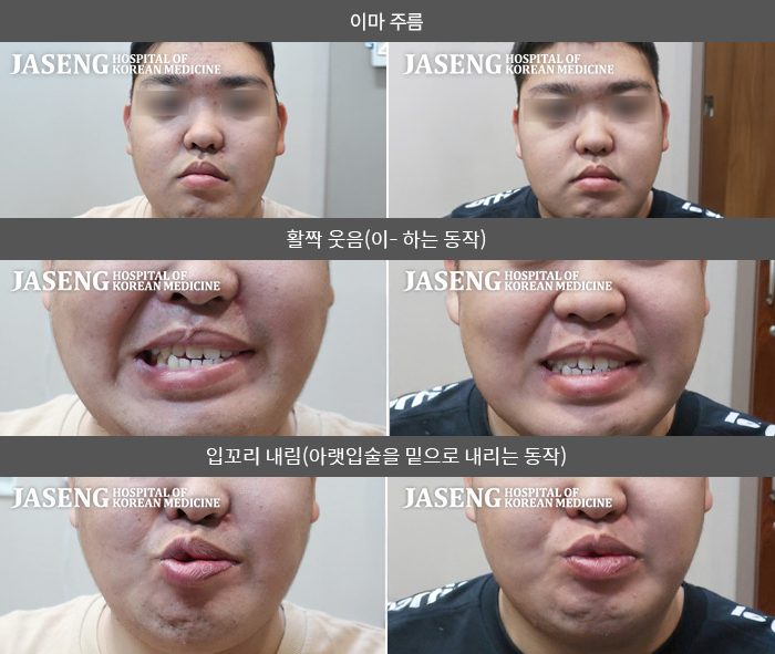 자생한방병원 치료사례 MRI로 보는 치료결과-어렸을 때부터 시작되어 군복무 중 5번째 재발한 안면신경마비