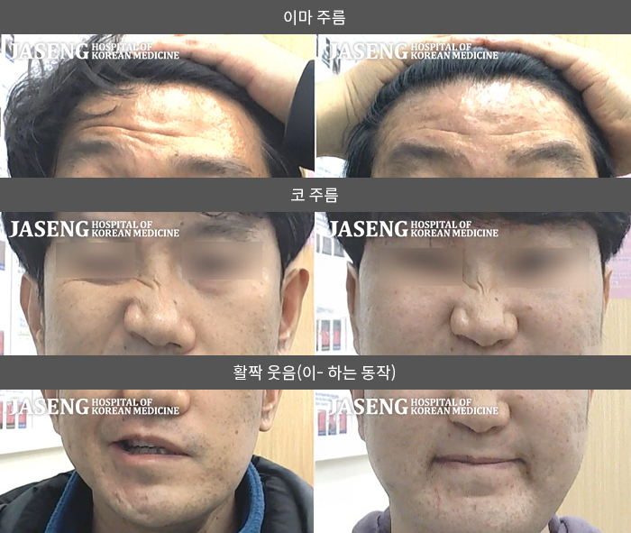 자생한방병원 치료사례 MRI로 보는 치료결과-좌측 눈이 안감겨서 눈이 시리고 눈물이남. 좌측 입이 마비되어 입이 우측으로 돌아가고 좌측안면에 감각이 떨어짐