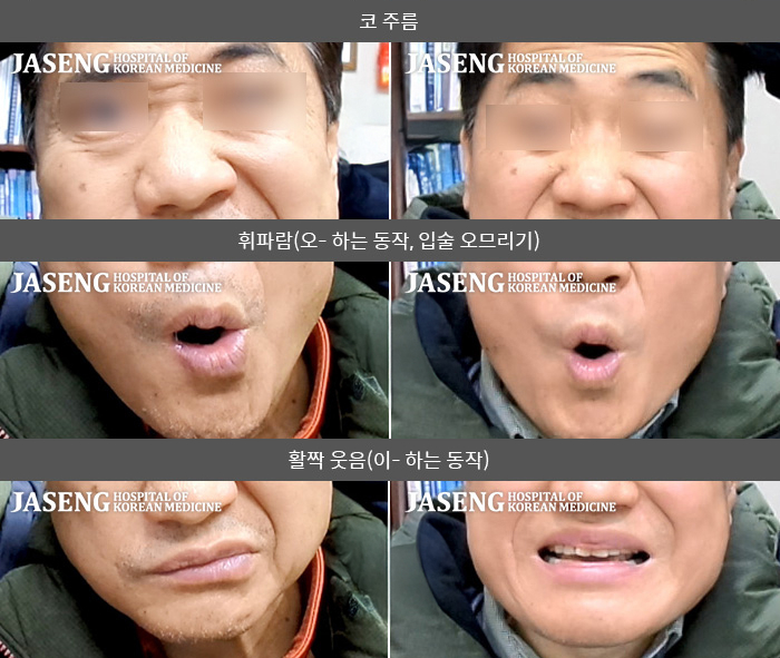 자생한방병원 치료사례 MRI로 보는 치료결과-우측 안면 마비