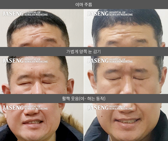 자생한방병원 치료사례 MRI로 보는 치료결과-두통 동반되어 눈감기 불가능, 구각부 움직임 저하로 물샘 지속 