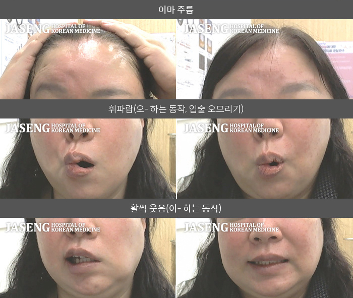 자생한방병원 치료사례 MRI로 보는 치료결과-왼쪽 눈이 감기고 않고 왼쪽 입주위가 마비되어 돌아가 양치할 때 물이 새었다. 물을  마실 때도 물이 새서 흐름