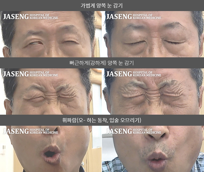 자생한방병원 치료사례 MRI로 보는 치료결과-우측 눈이 안감겨서 불편하고 눈물이 새는 경향이 있었다.  입주위가 힘이 빠지고 돌아가 비대칭이다.