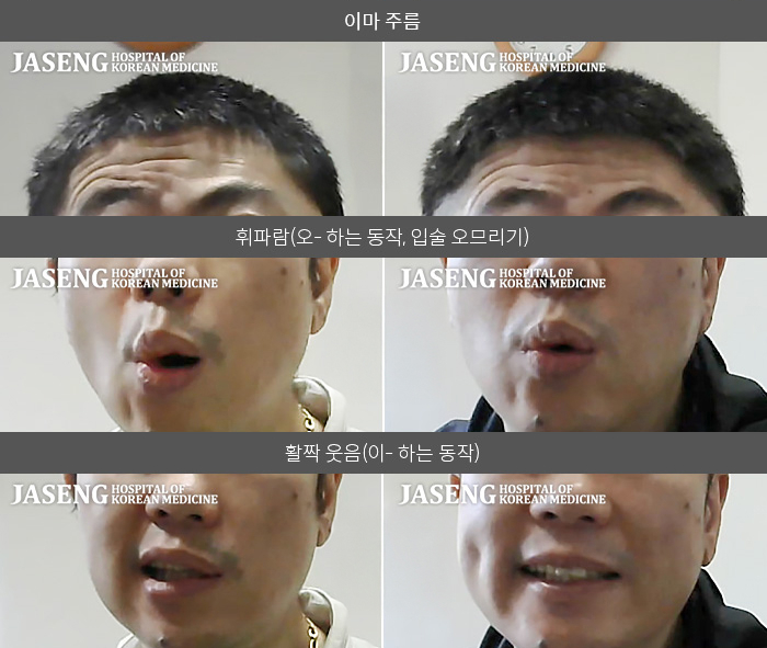 자생한방병원 치료사례 MRI로 보는 치료결과-혀 감각이 이상하면서 생긴 안면신경마비