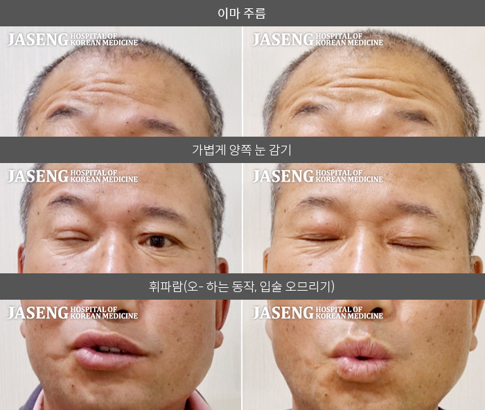 자생한방병원 치료사례 MRI로 보는 치료결과-스트레스가 심한 상태로, 후두부 통증 심한 상태로, 양치 하던 중 입에서 물이 새면서 발견하였다.