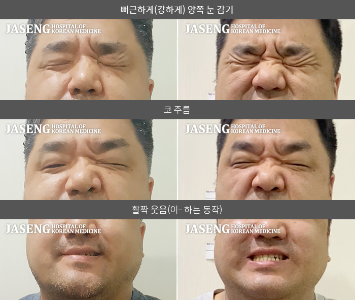 자생한방병원 치료사례 MRI로 보는 치료결과-스트레스가 심한 상태에서 안면마비 발생, 두통 동반, 우측 입술 및 주변부로 떨리는 듯한 느낌과 마비된 느낌