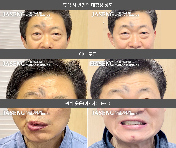 자생한방병원 치료사례 MRI로 보는 치료결과-왼쪽 눈이 잘 안 감기고 물을 마실 때 흘러 내린다.