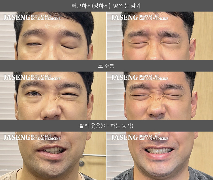 자생한방병원 치료사례 MRI로 보는 치료결과-우측 눈, 코, 입, 혀까지 안 움직인다. 우측 눈이 완전히 안 감긴다. 음식을 먹거나 물을 마실 때 흐를려고 한다.