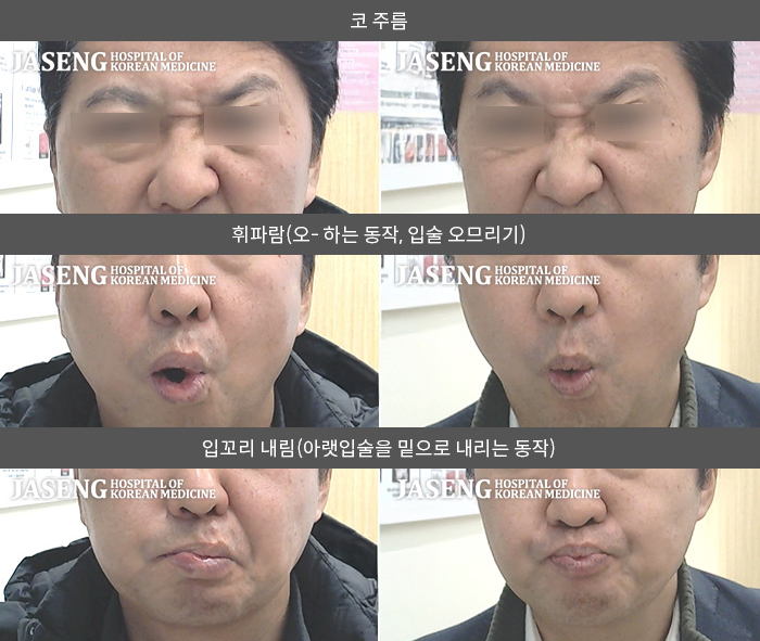 자생한방병원 치료사례 MRI로 보는 치료결과-2016년 우측 안면마비 발생 후 다시 2022년 우측 안면마비 발생