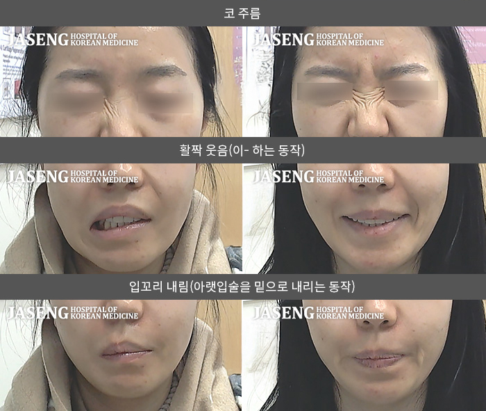 자생한방병원 치료사례 MRI로 보는 치료결과-육아 과로와 TV 장시간 시청 후 안면피로감을 느낌. 그 후 안면마비 발생