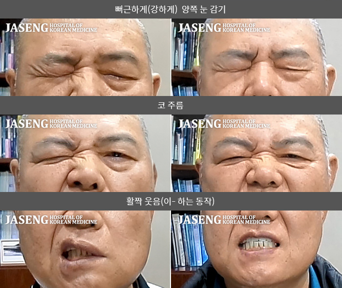 자생한방병원 치료사례 MRI로 보는 치료결과-좌측 안면부위의 마비 증상