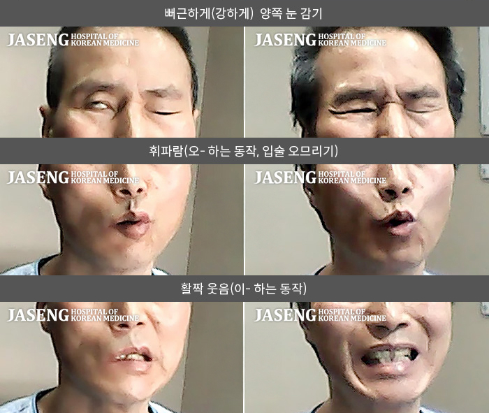 자생한방병원 치료사례 MRI로 보는 치료결과-이마에 주름을 잡을 수 없고, 눈물이 많았으며, 입에서 음식물들이 줄줄 샜다.