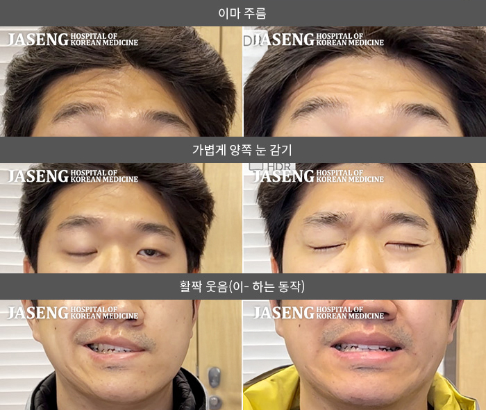 자생한방병원 치료사례 MRI로 보는 치료결과-좌측 눈이 안 감긴다. 좌측 안면으로 마비가 되어서 발음이 조금 새고, 음식 먹는 것도 힘들다. 미각도 둔해진 느낌이 든다. 