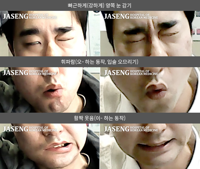 자생한방병원 치료사례 MRI로 보는 치료결과-이마에 주름을 잡을 수 없고, 안구건조 증상이 나타났으며 입에서 침이 지속적으로 흐름