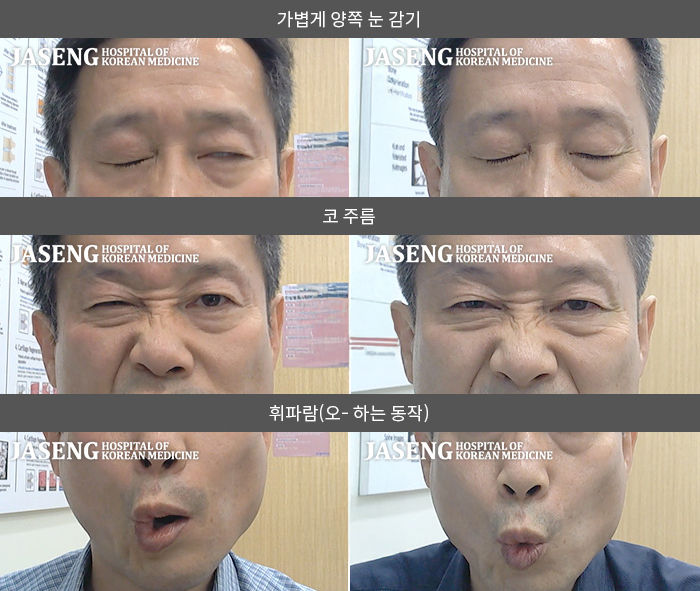 자생한방병원 치료사례 MRI로 보는 치료결과-이유없이 아침에 일어난 후  좌측 안면마비 발생 