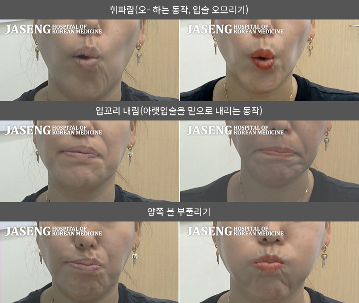 자생한방병원 치료사례 MRI로 보는 치료결과-눈감기가 부자연스럽고  우측 입술이나 볼 근육마비로  양치 시 물이 새고 입이 좌측으로 돌아감 