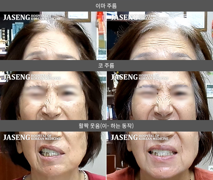자생한방병원 치료사례 MRI로 보는 치료결과-좌측 안면 마비