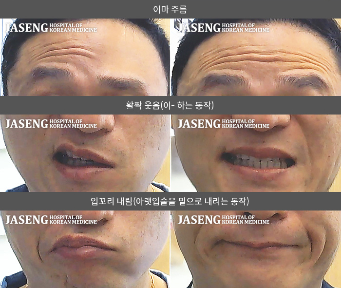 자생한방병원 치료사례 MRI로 보는 치료결과-별무 이유 없이  좌측 안면마비 발생해 1일후 초기부터  내원  본원 양약 처방 및  입원치료 병행 