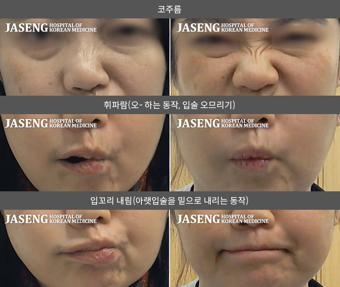 자생한방병원 치료사례 MRI로 보는 치료결과-2024.11.25우측안면마비 발생 양방 이비인후과에서 양약처방 후 내원 우측 눈감기 우측 코, 입술 마비로 내원