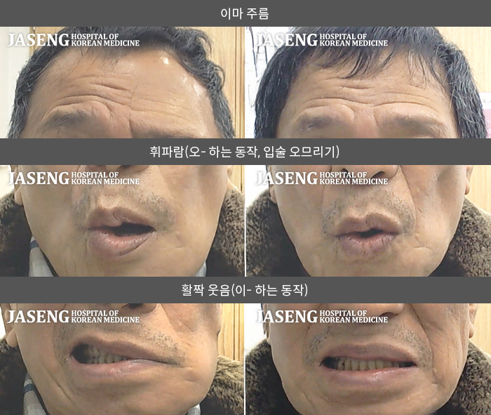 자생한방병원 치료사례 MRI로 보는 치료결과-2024.11.25좌측안면마비 발생 고혈압 당뇨 이환중 좌측이마 주름잡기 안되고  눈감기  코, 입술 마비로 내원