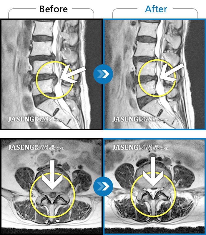 자생한방병원 치료사례 MRI로 보는 치료결과-왼쪽으로 골반과 엉덩이부터 발목까지 통증