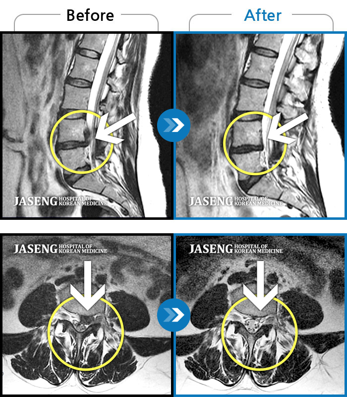 자생한방병원 치료사례 MRI로 보는 치료결과-좌측 둔부 통증 및 좌측 하지 통증