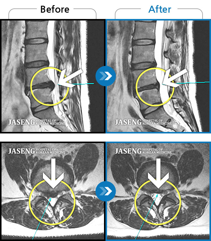 자생한방병원 치료사례 MRI로 보는 치료결과-요통, 우측 엉치 통증 및 양측 종아리 비증