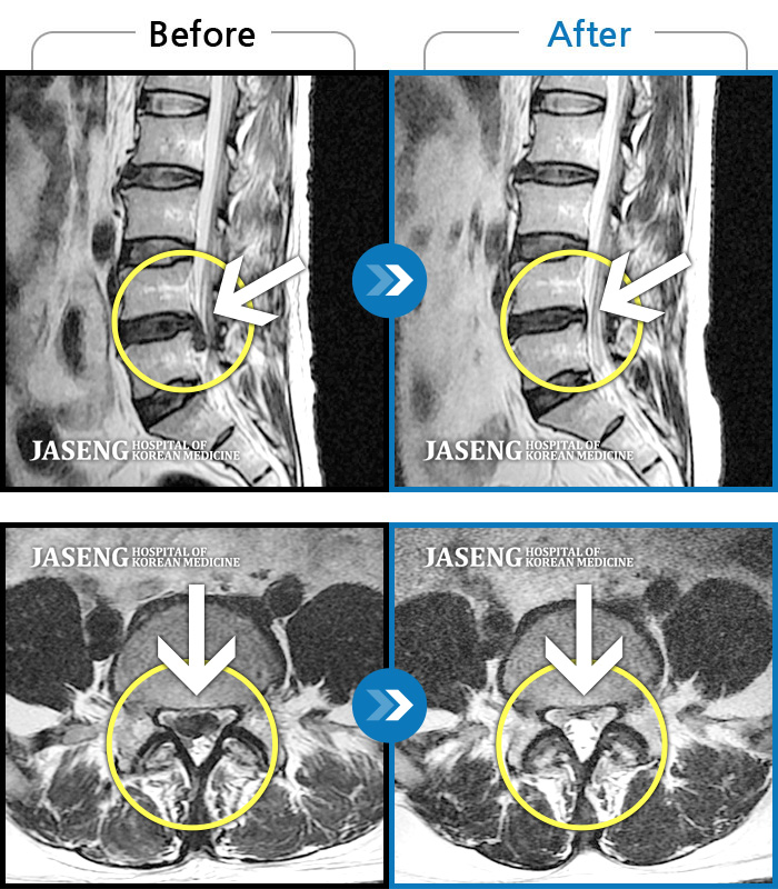 자생한방병원 치료사례 MRI로 보는 치료결과-우측 하지 방사통, 거동불가