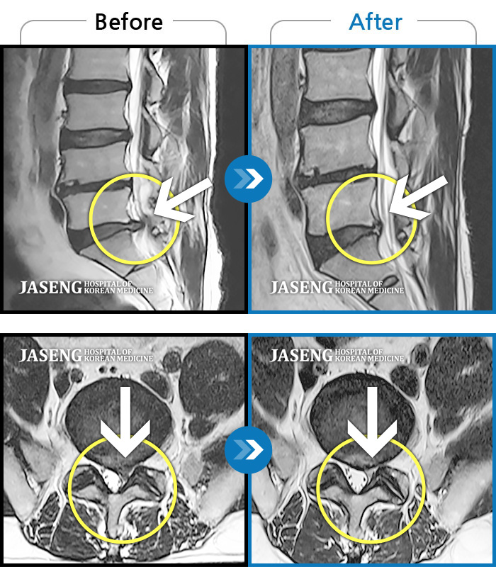 자생한방병원 치료사례 MRI로 보는 치료결과-서 있거나 움직일 때 좌측 골반통증 및 좌측 하지 방사통과 발바닥 저림