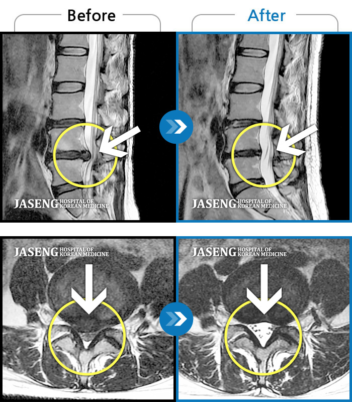 자생한방병원 치료사례 MRI로 보는 치료결과-우측 허리 다리 통증으로 야간통, 보행장애