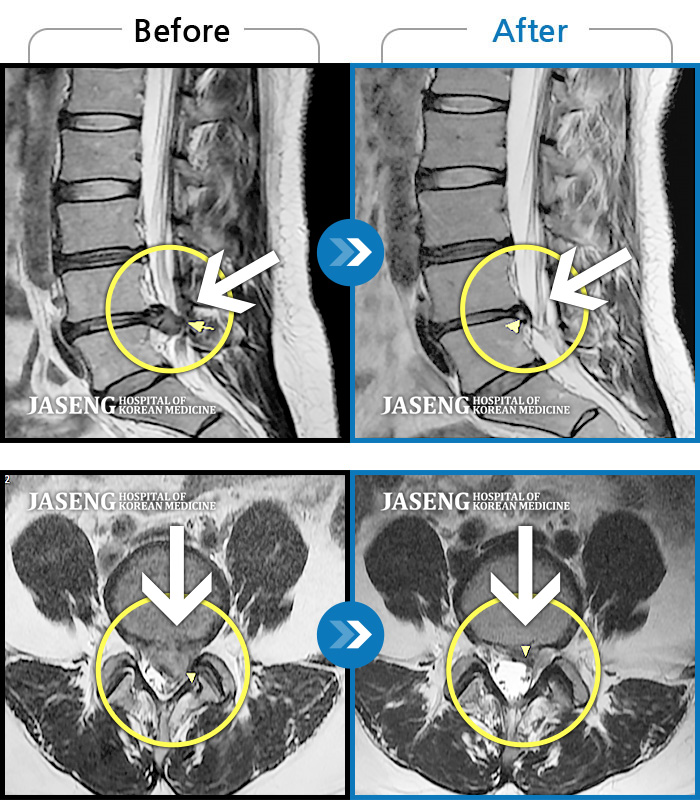 자생한방병원 치료사례 MRI로 보는 치료결과-좌하지 방사통, 야간통
