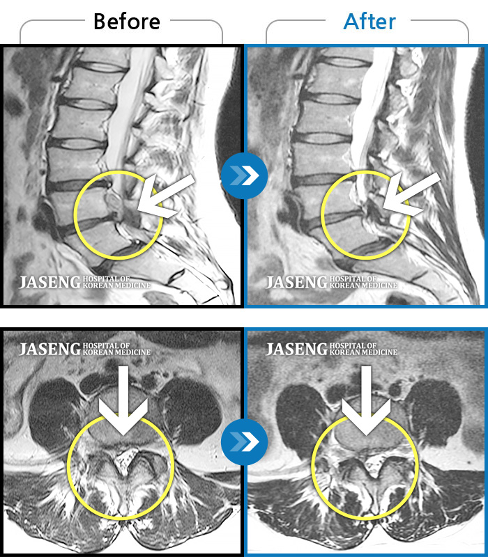 자생한방병원 치료사례 MRI로 보는 치료결과-허리 골반통증 및 우하지 방사통, 감각저하