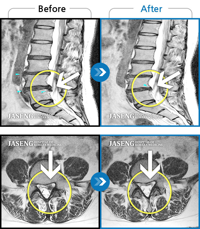 자생한방병원 치료사례 MRI로 보는 치료결과-허리 통증 및  좌하지 방사통