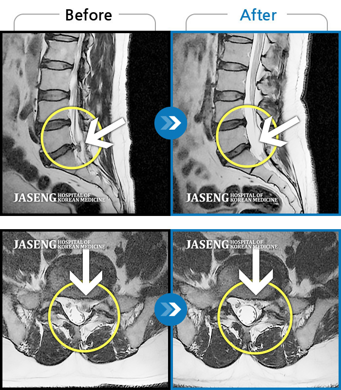 자생한방병원 치료사례 MRI로 보는 치료결과-좌측 하지 저림 증상