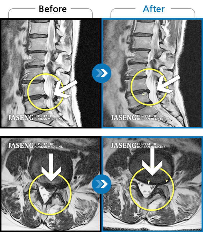 자생한방병원 치료사례 MRI로 보는 치료결과-허리통증, 좌측 다리 저림 및 근력 저하