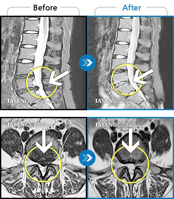 자생한방병원 치료사례 MRI로 보는 치료결과-좌측 허리 골반 및 하지 방사통, 야간통