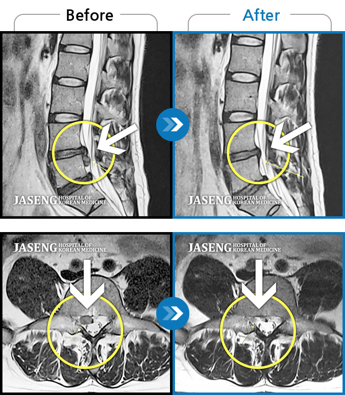자생한방병원 치료사례 MRI로 보는 치료결과-하부 요추, 우측 다리까지 통증. 앉았다가 일어날때, 허리 펼때 통증