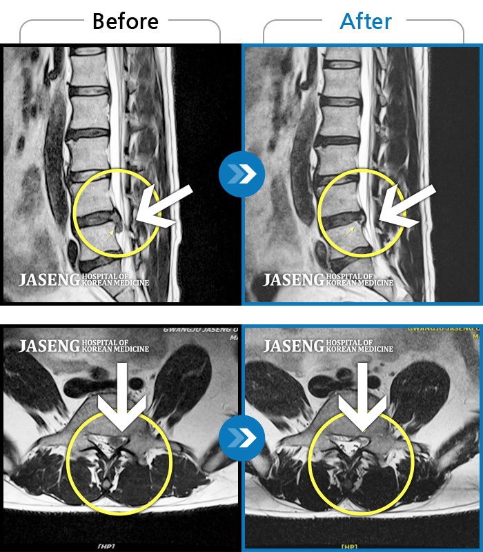 자생한방병원 치료사례 MRI로 보는 치료결과-하부 요추, 골반 양측 통증, 좌측 다리 당김 및 통증