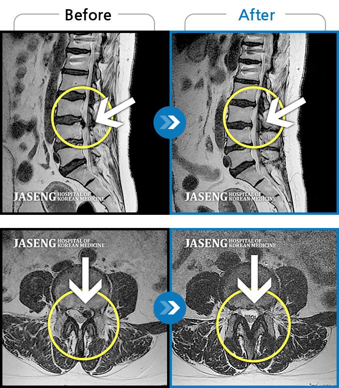 자생한방병원 치료사례 MRI로 보는 치료결과-허리통증과 좌측 하지방사통 
